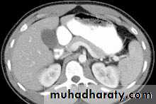Endoscopic GIT