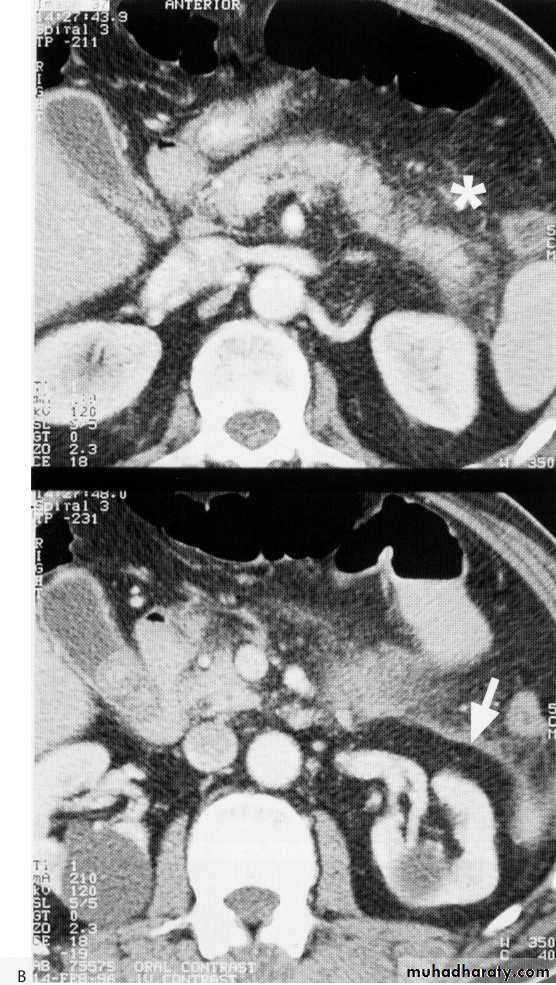 Endoscopic GIT