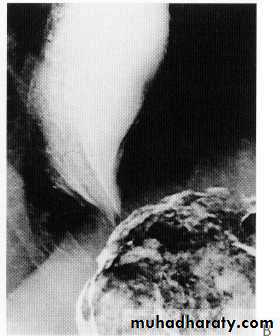 Endoscopic GIT