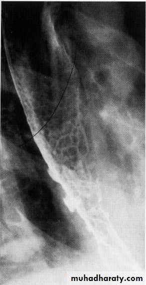 Endoscopic GIT