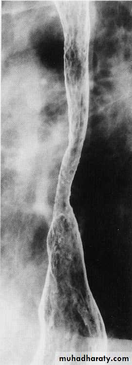 Endoscopic GIT