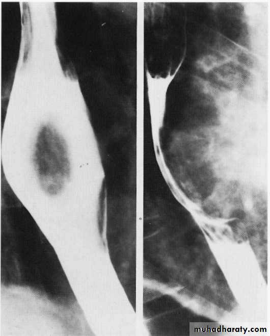 Endoscopic GIT