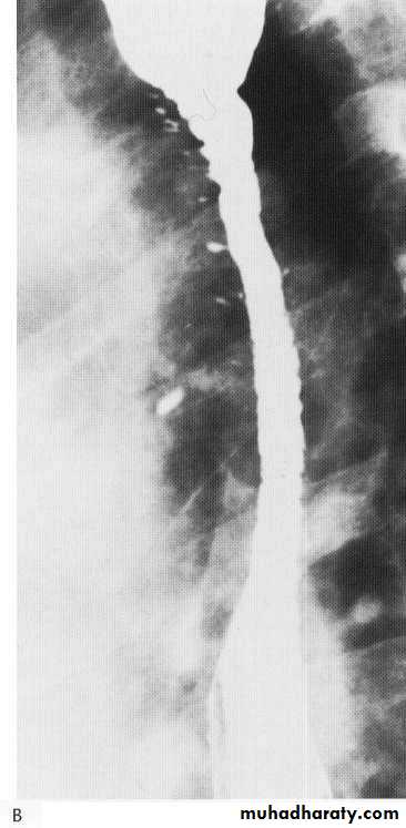 Endoscopic GIT