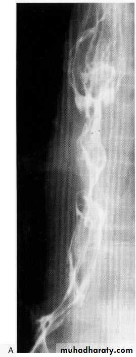 Endoscopic GIT