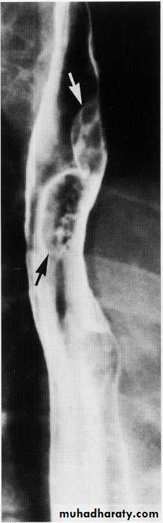 Endoscopic GIT