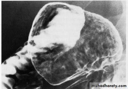 Endoscopic GIT