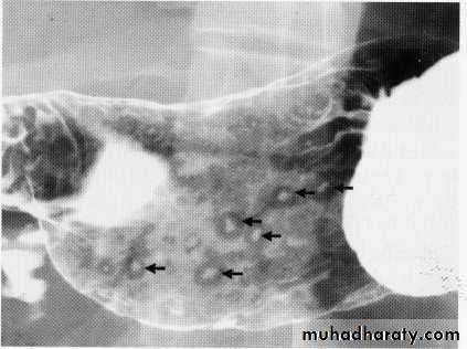 Endoscopic GIT