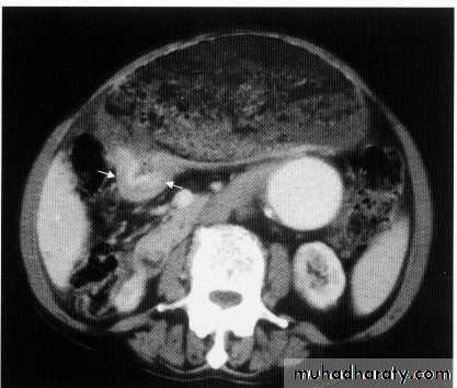 Endoscopic GIT