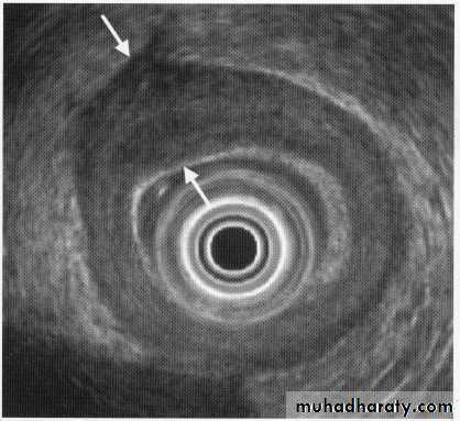 Endoscopic GIT