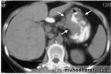 Endoscopic GIT
