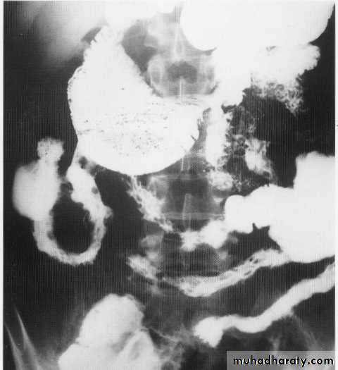 Endoscopic GIT