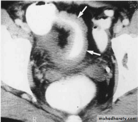 Endoscopic GIT