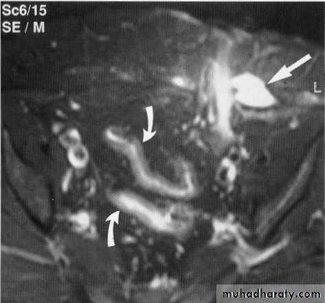 Endoscopic GIT