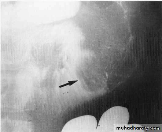 Endoscopic GIT