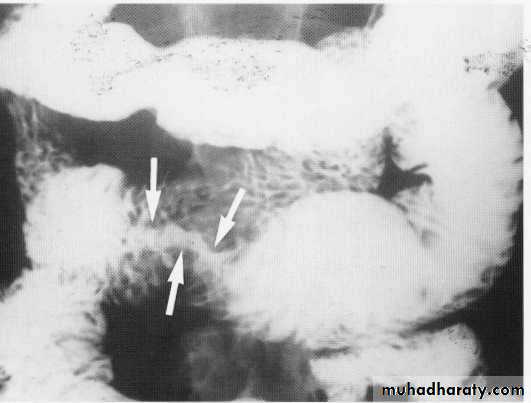 Endoscopic GIT