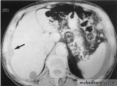 Endoscopic GIT