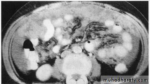 Endoscopic GIT
