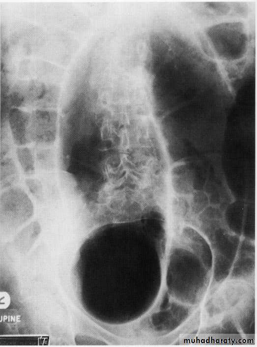 Endoscopic GIT