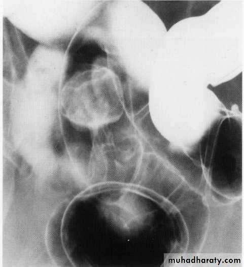 Endoscopic GIT