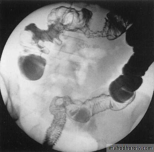 Endoscopic GIT
