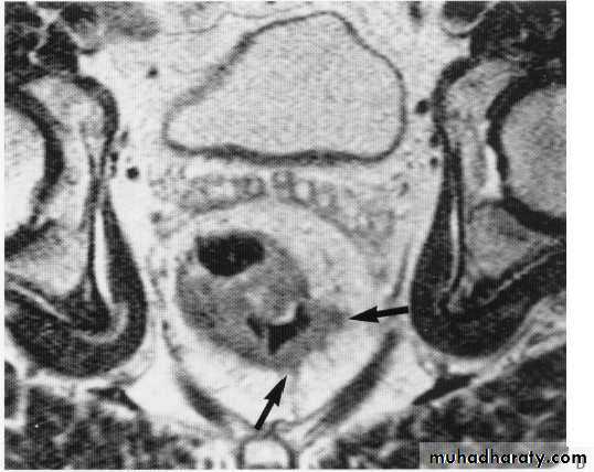 Endoscopic GIT