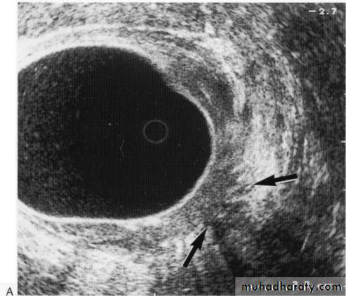 Endoscopic GIT