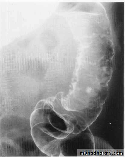 Endoscopic GIT