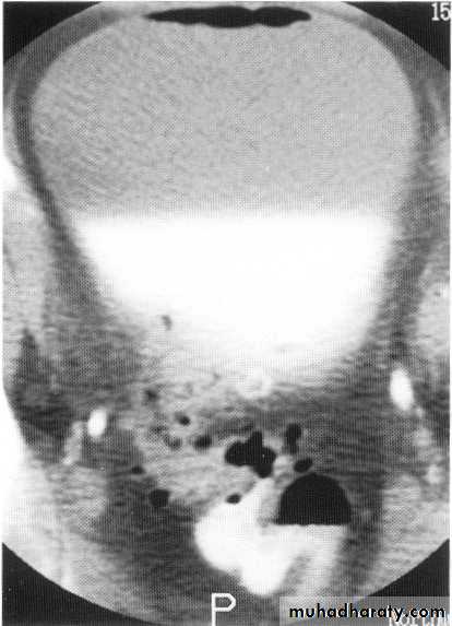 Endoscopic GIT