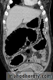 Endoscopic GIT