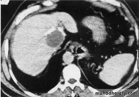 Endoscopic GIT