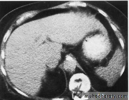Endoscopic GIT