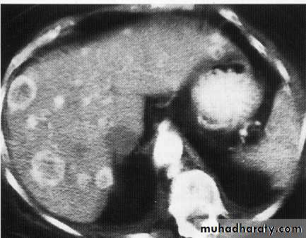 Endoscopic GIT