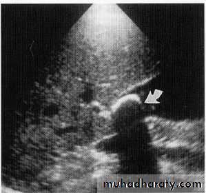 Endoscopic GIT