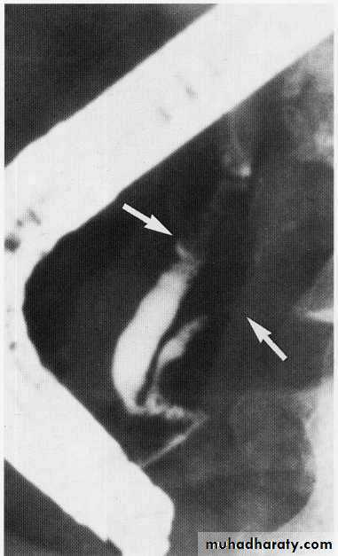 Endoscopic GIT