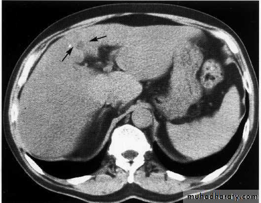 Endoscopic GIT