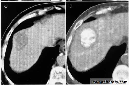 Endoscopic GIT