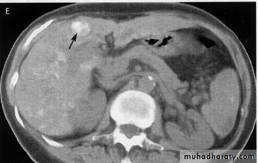 Endoscopic GIT