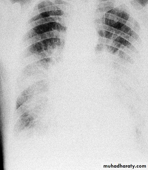 Heart failure 1