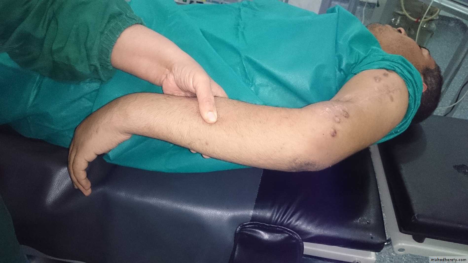 Upper limbs orthopedic