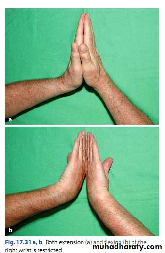 Upper limbs orthopedic