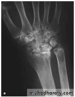 Upper limbs orthopedic