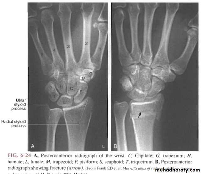Upper limbs orthopedic