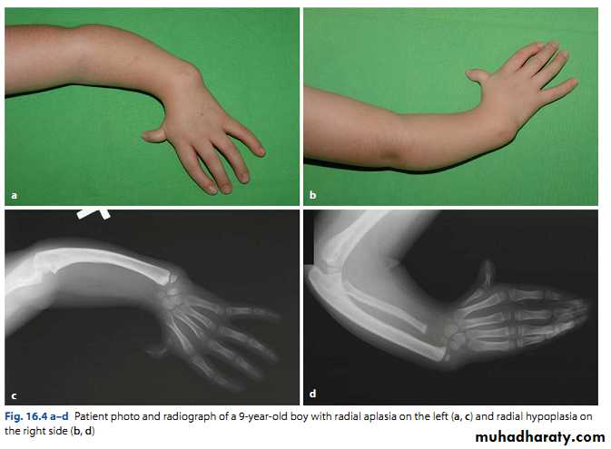 Upper limbs orthopedic