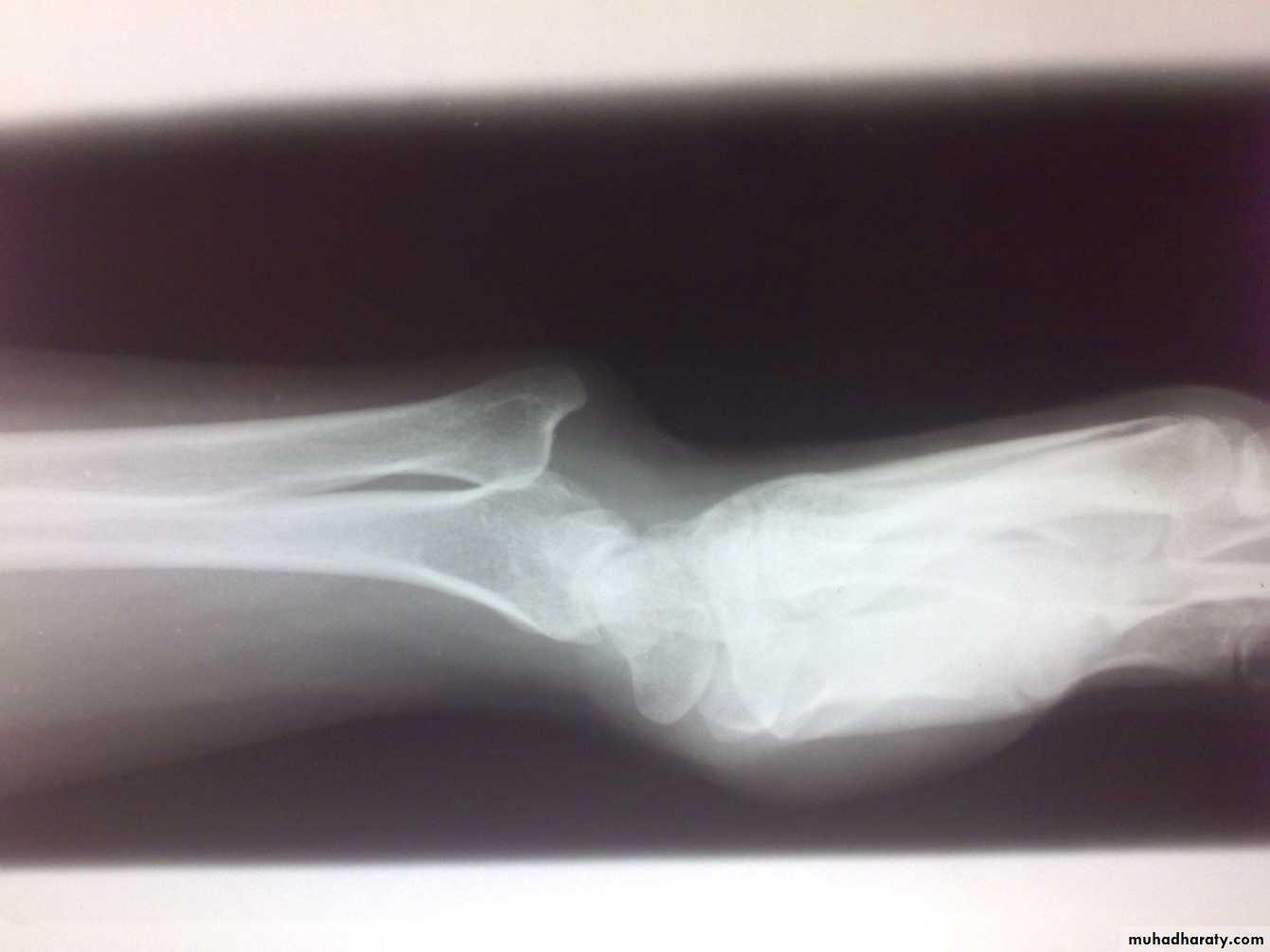 Upper limbs orthopedic