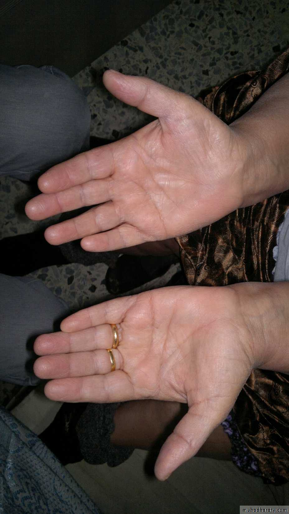 Upper limbs orthopedic