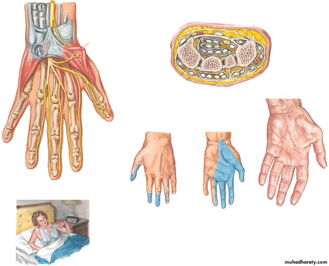 Upper limbs orthopedic