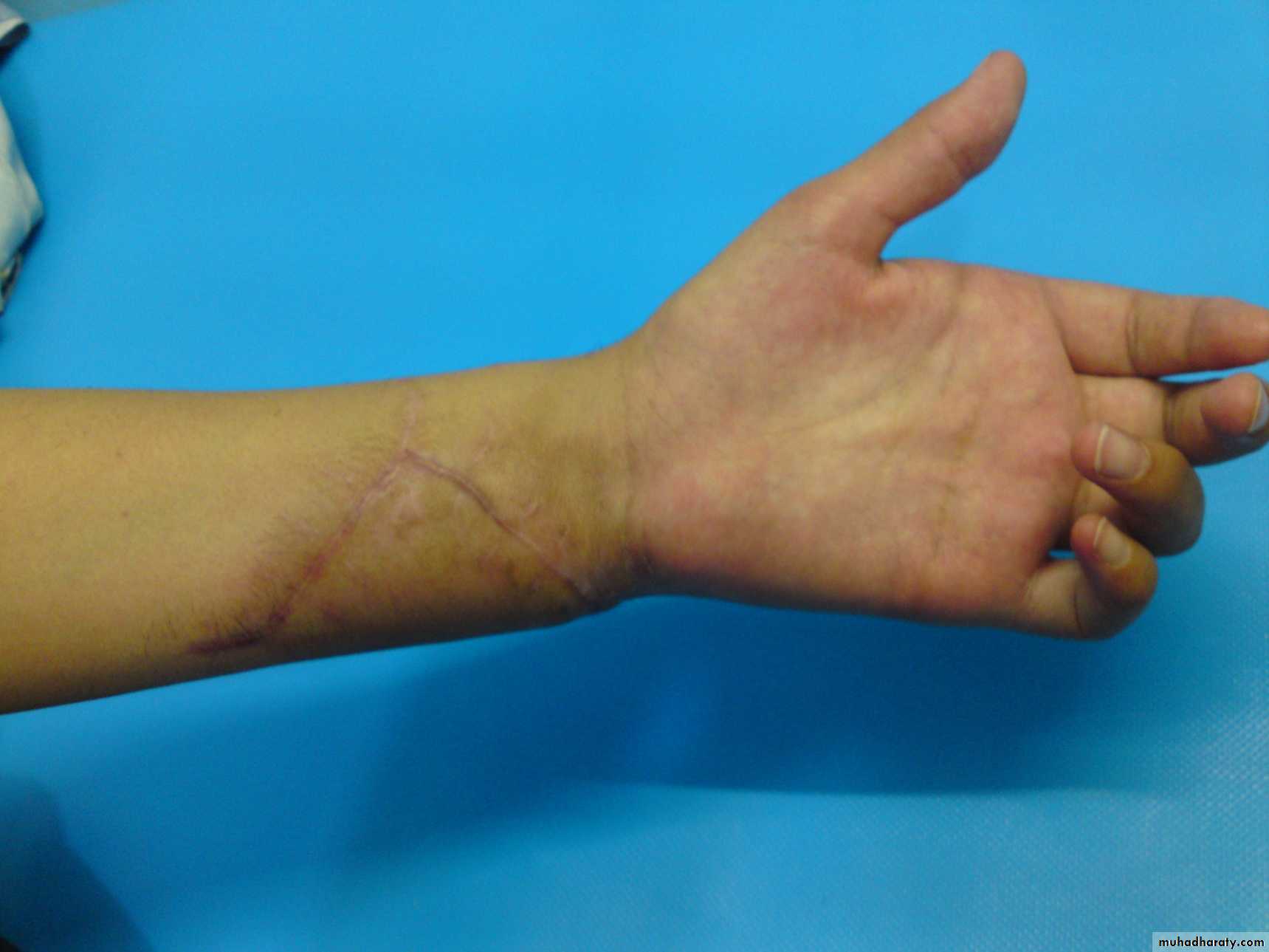 Upper limbs orthopedic