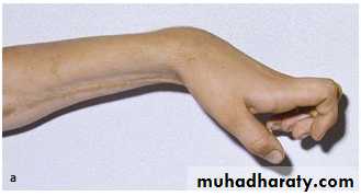Upper limbs orthopedic