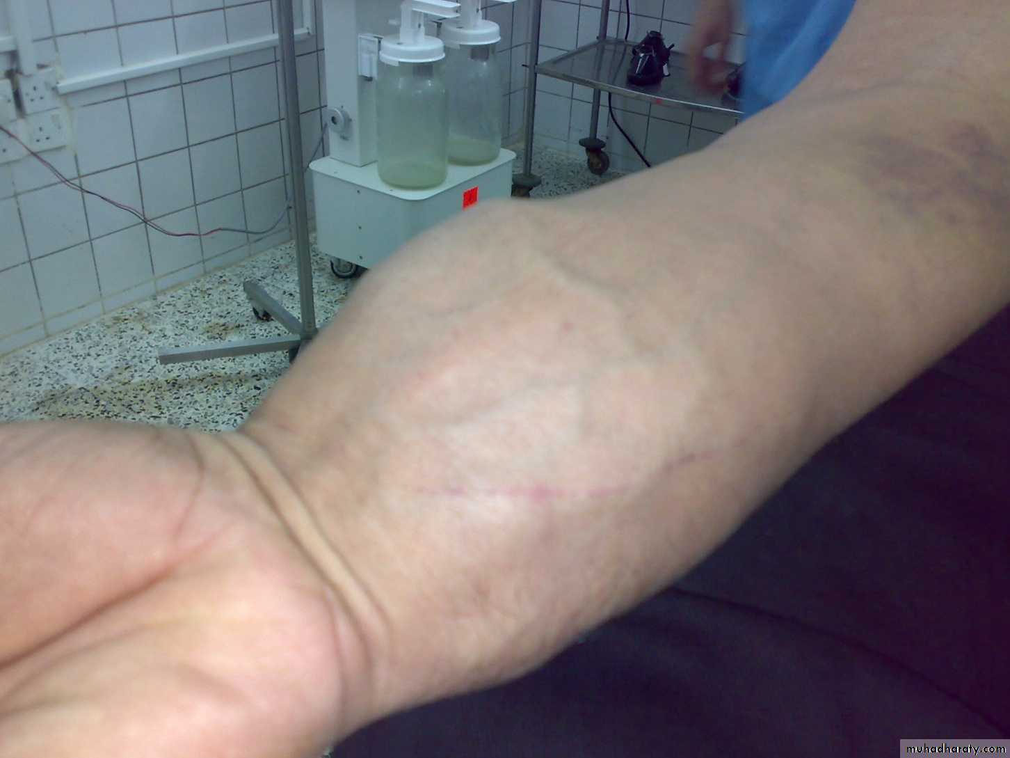 Upper limbs orthopedic