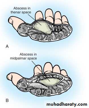 Upper limbs orthopedic